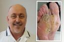 Podiatrist Matthew Bland used the Alloa firm's technology to treat the 56-year-old verruca